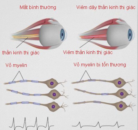 Viêm dây thần kinh thị giác - Hình ảnh minh họa